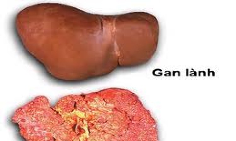 Các yếu tố làm tăng nguy cơ mắc ung thư Gan