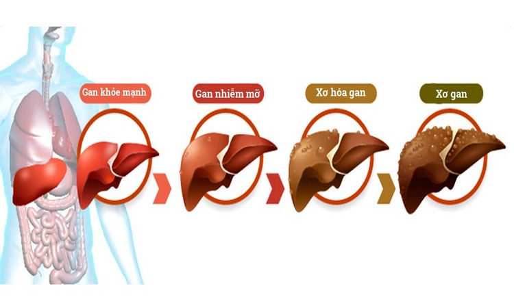 Nấm Ngưu Chương Chi - Sản phẩm bảo vệ Gan hiệu quả hiện nay