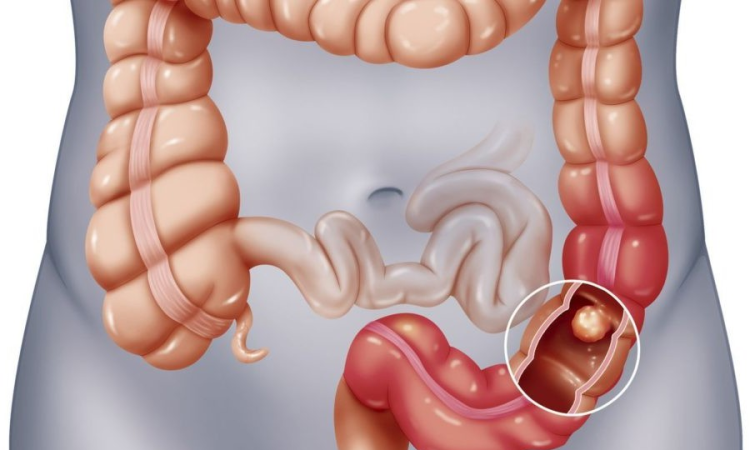 BỆNH VIÊM ĐẠI TRÀNG CÓ NGUY HIỂM KHÔNG 