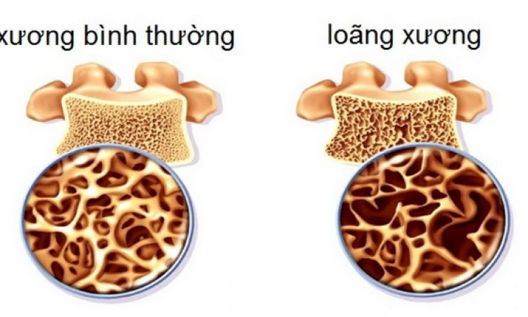 BỆNH LOÃNG XƯƠNG CÓ NGUYÊN NHÂN DO ĐÂU 